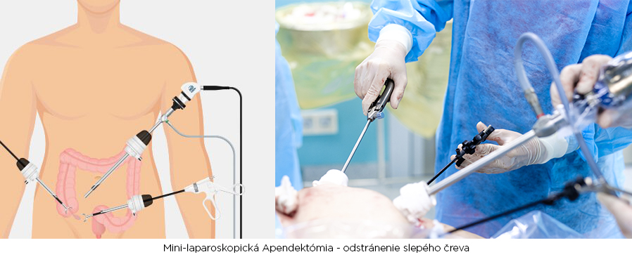 Apendektómia operácia slepého čreva mini-laparoskopia