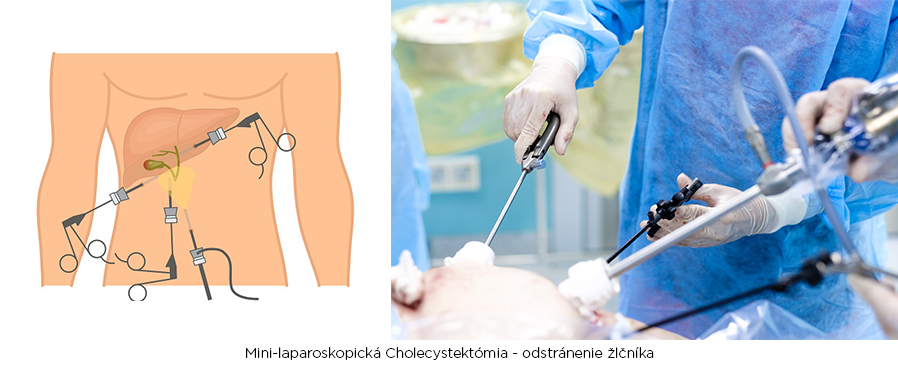 cholecystektomia mini-laparoskopicka operacia zlcnika